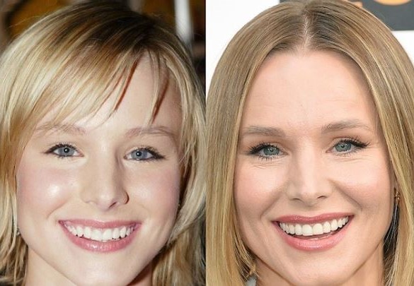 celebrities-with-veneers-Kristen Bell celebrities-with-veneers-Kristen Bell