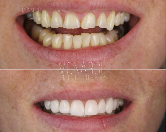 What are the advantages of dental laminate veneers?