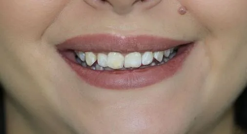 before composite bonding