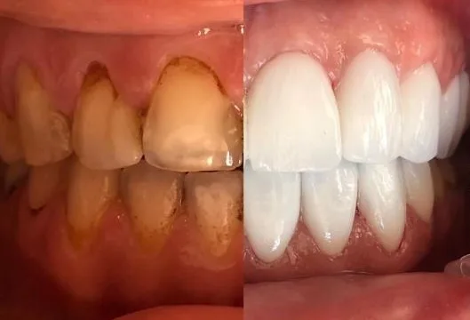 Laminate Veneers Teeth procedure in Turkey
