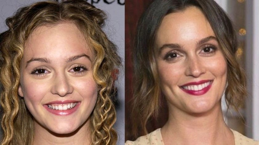 celebrities-with-veneers-Leighton Meester celebrities-with-veneers-Leighton Meester