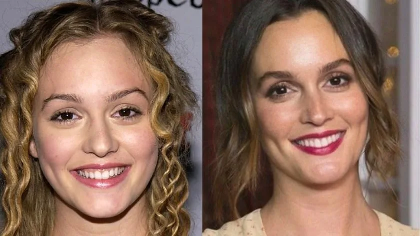 celebrities-with-veneers-Leighton Meester celebrities-with-veneers-Leighton Meester