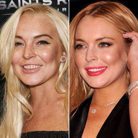 celebrities-with-veneers-Lindsay Lohan celebrities-with-veneers-Lindsay Lohan