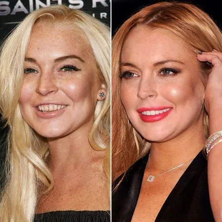 celebrities-with-veneers-Lindsay Lohan celebrities-with-veneers-Lindsay Lohan