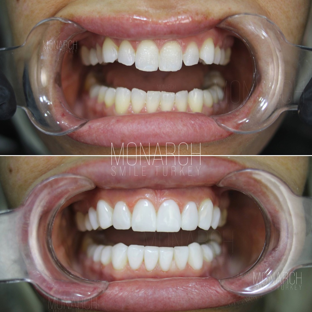 Veneers before and after-1
