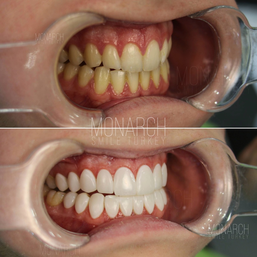 Veneers before and after-10