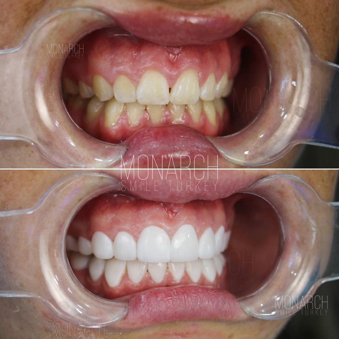 Veneers before and after-2