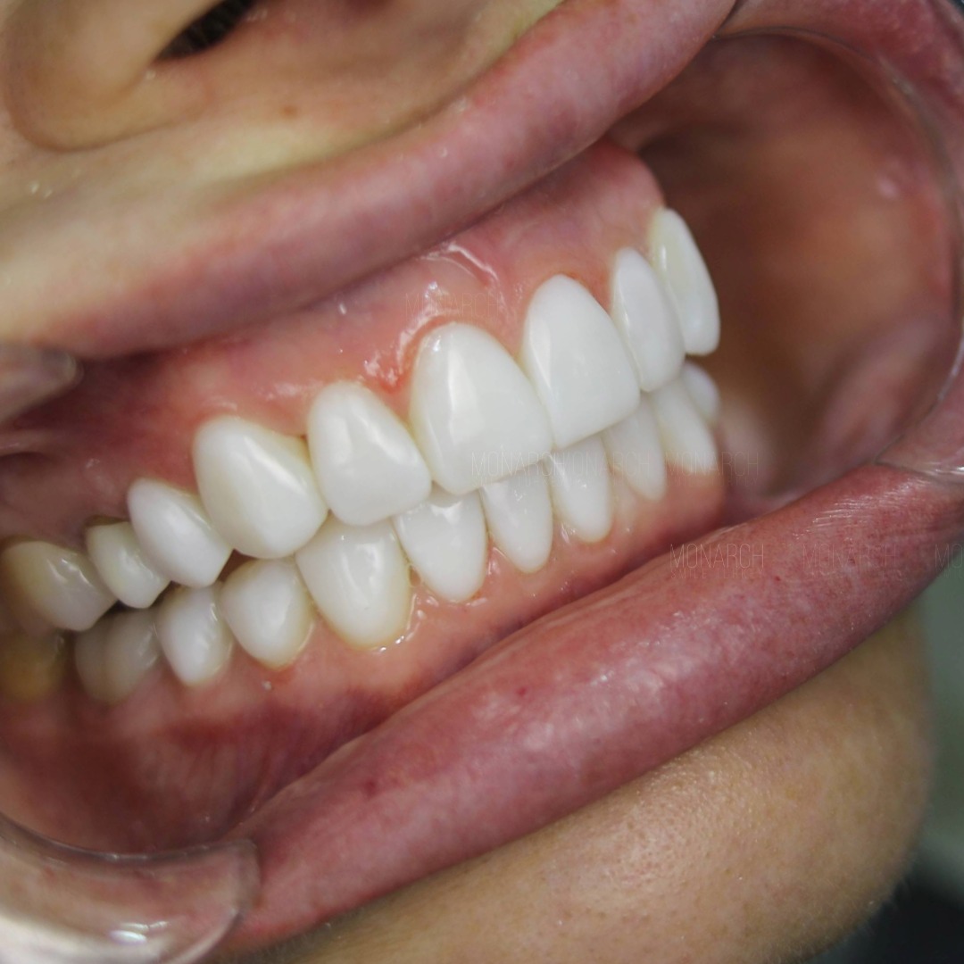 Veneers before and after-3