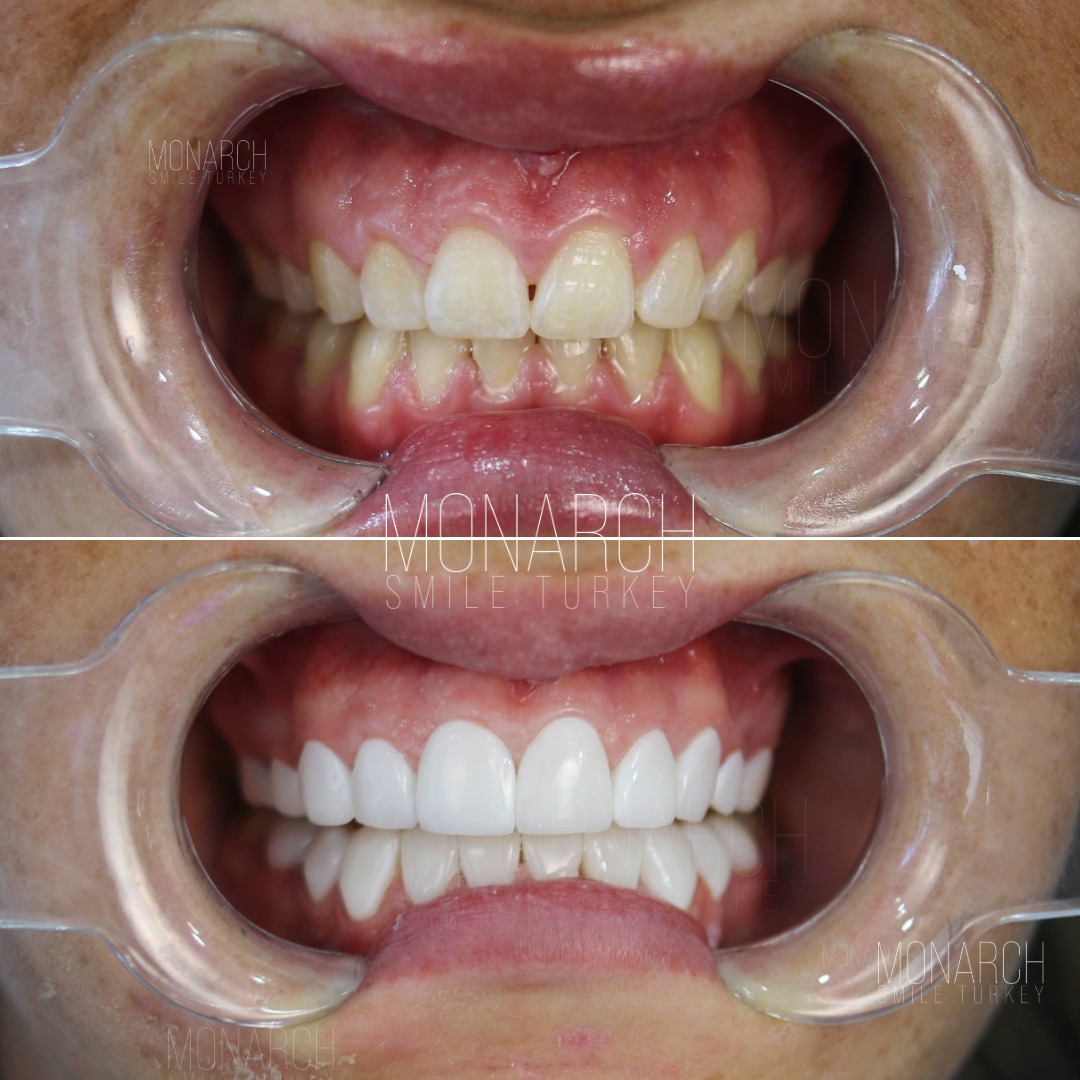 Veneers before and after-4