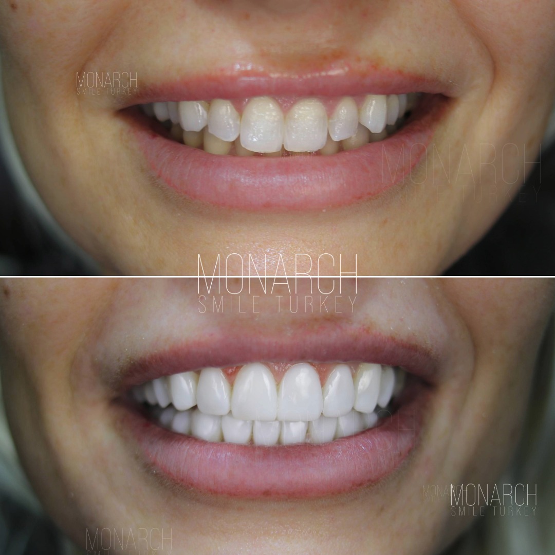 Veneers before and after-5