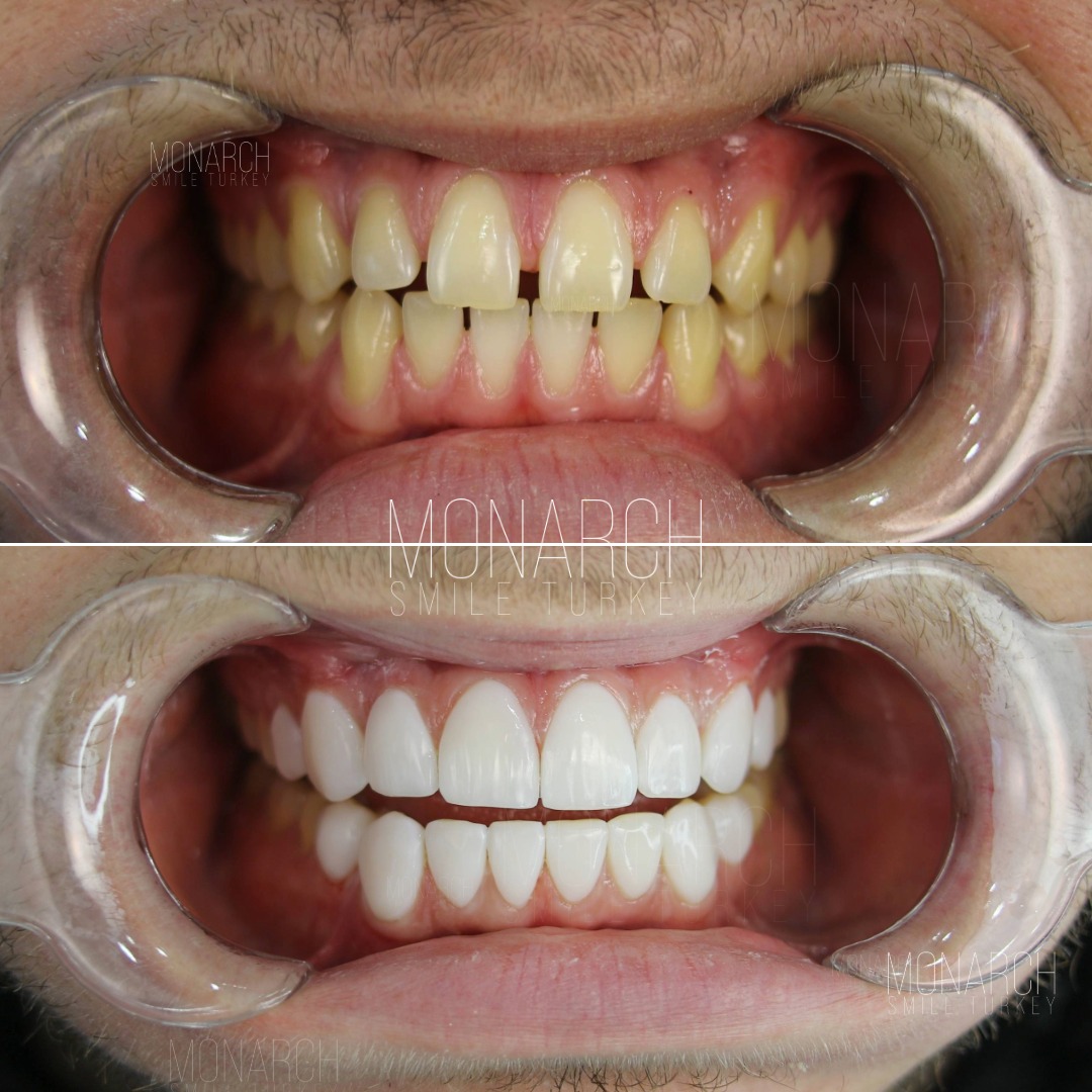 Veneers before and after-6