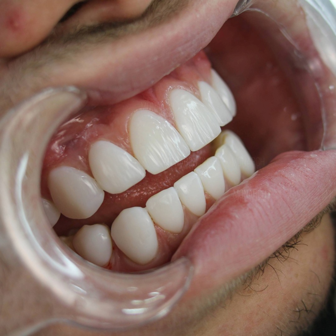 Veneers before and after-7