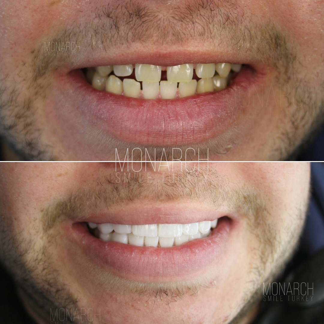 Veneers before and after-8