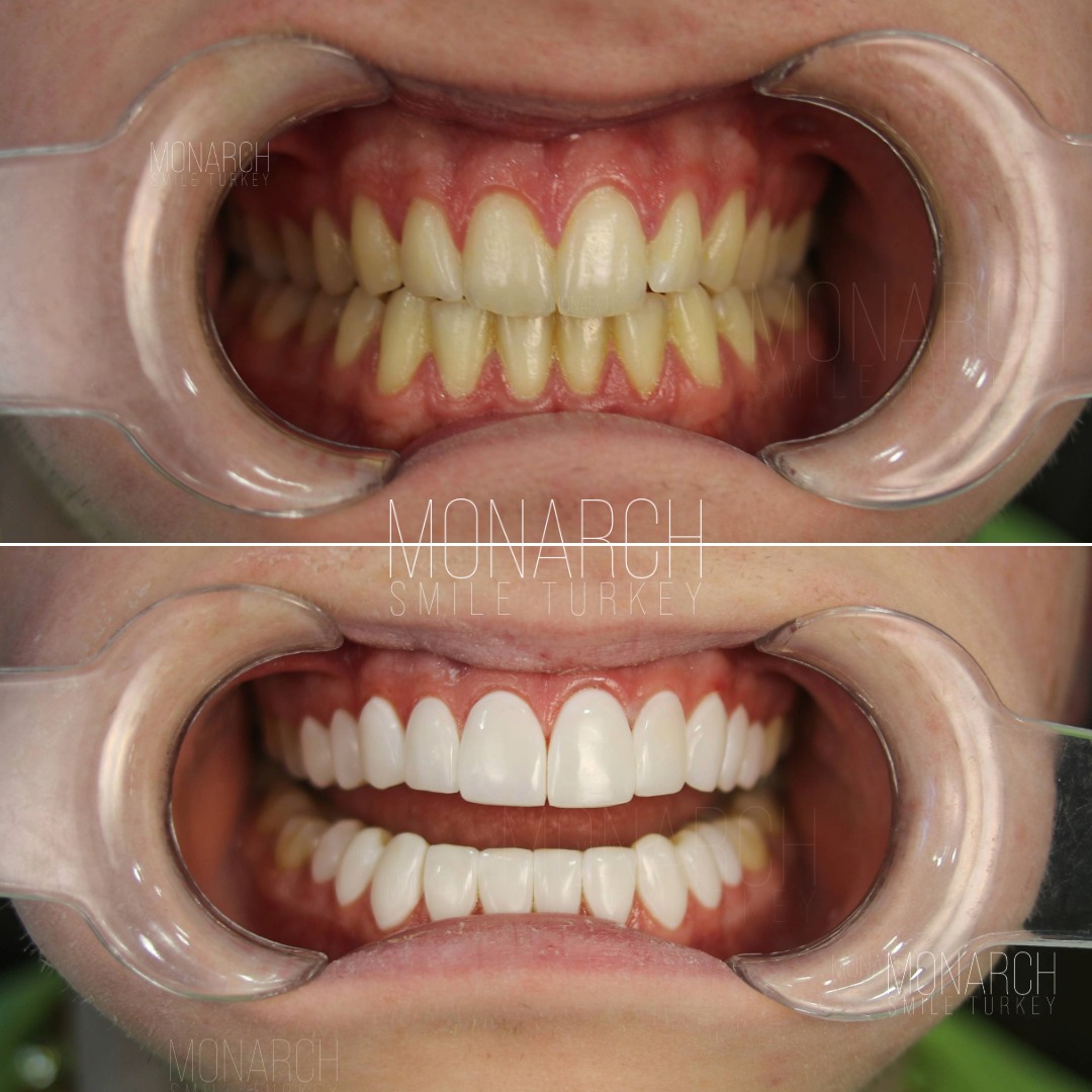 Veneers before and after-9