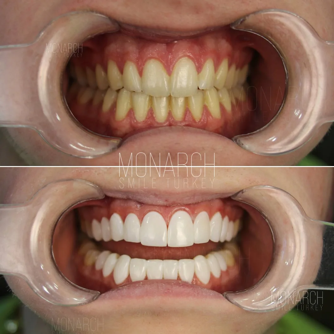 Veneers before and after-9