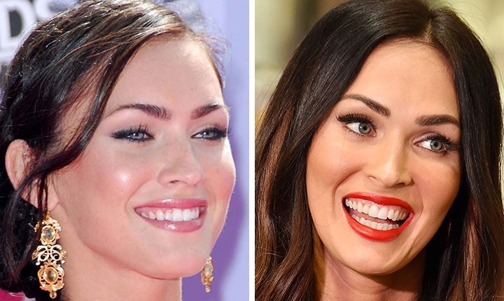 celebrities-with-veneers-megan-fox celebrities-with-veneers-megan-fox