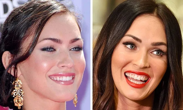 celebrities-with-veneers-megan-fox celebrities-with-veneers-megan-fox