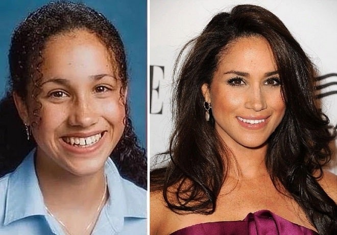 celebrities-with-veneers-Meghan Markle celebrities-with-veneers-Meghan Markle