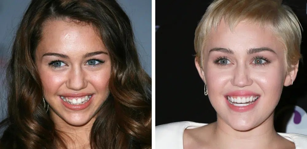 celebrities-with-veneers-Miley Cyrus celebrities-with-veneers-Miley Cyrus