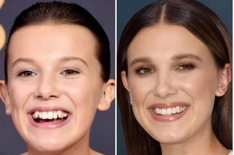 celebrities-with-veneers-Millie Bobby Brown celebrities-with-veneers-Millie Bobby Brown