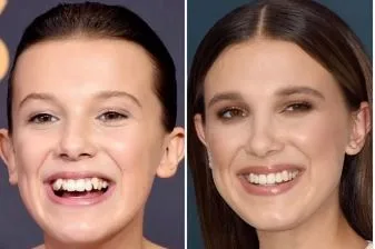 celebrities-with-veneers-Millie Bobby Brown celebrities-with-veneers-Millie Bobby Brown