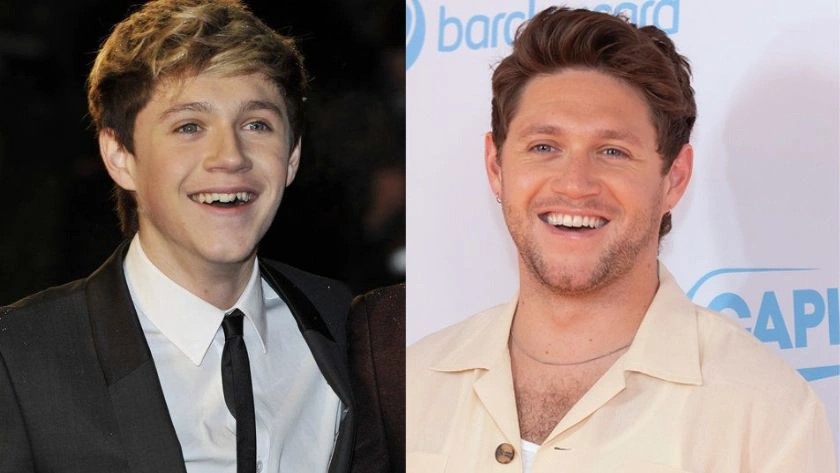 celebrities-with-veneers-Niall Horan celebrities-with-veneers-Niall Horan