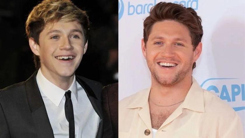celebrities-with-veneers-Niall Horan celebrities-with-veneers-Niall Horan