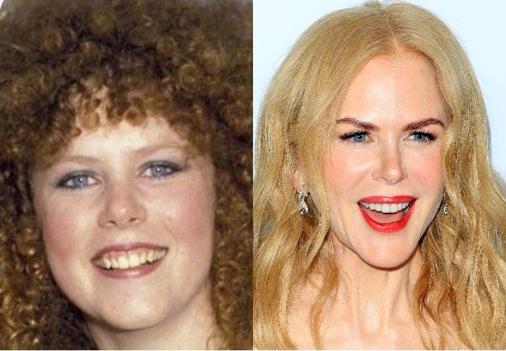 celebrities-with-veneers-nicole-kidman celebrities-with-veneers-nicole-kidman