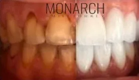 Porcelain Crowns Porcelain Veneers and Crowns in Turkey