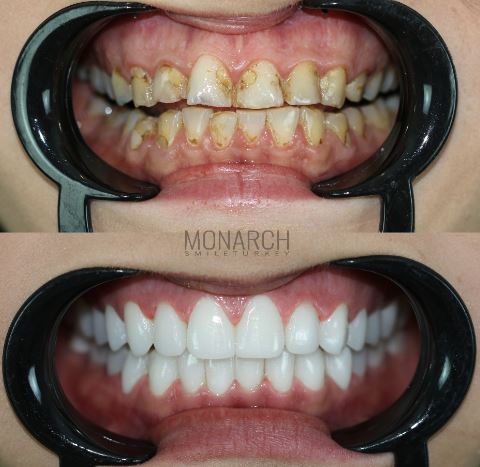 Porcelain Veneers and Crowns Prices in Turkey