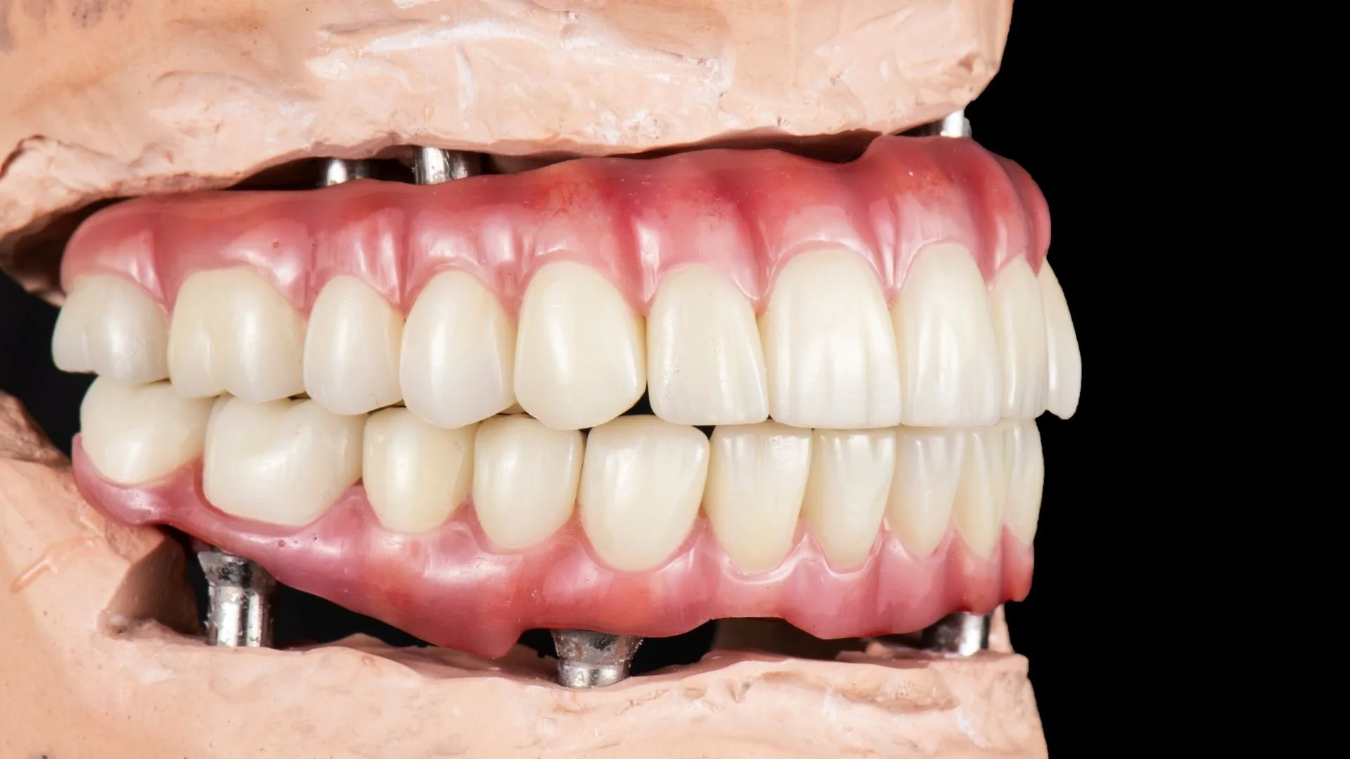 Candidates for one-day dental implants Dental Implants Candidates for one-day dental implants Turkey Antalya
