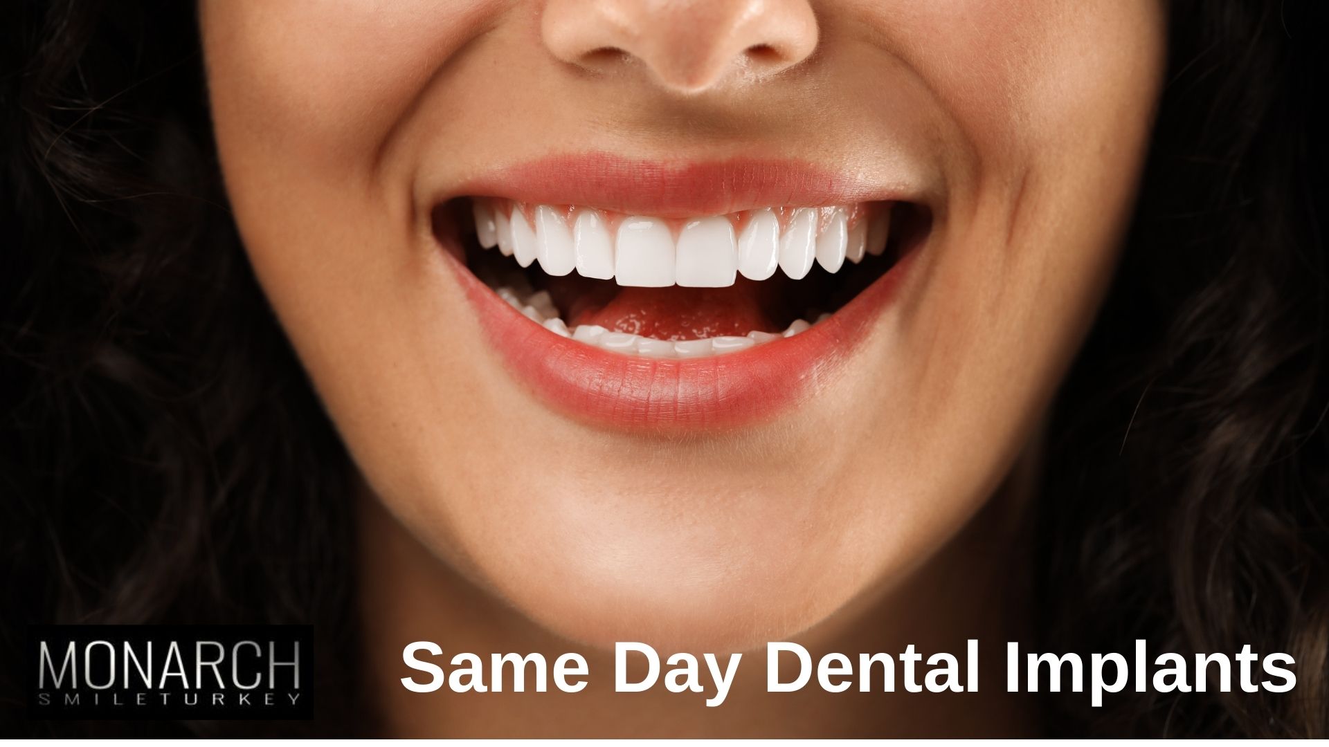 same-day-dental-implants-in-turkey-antalya