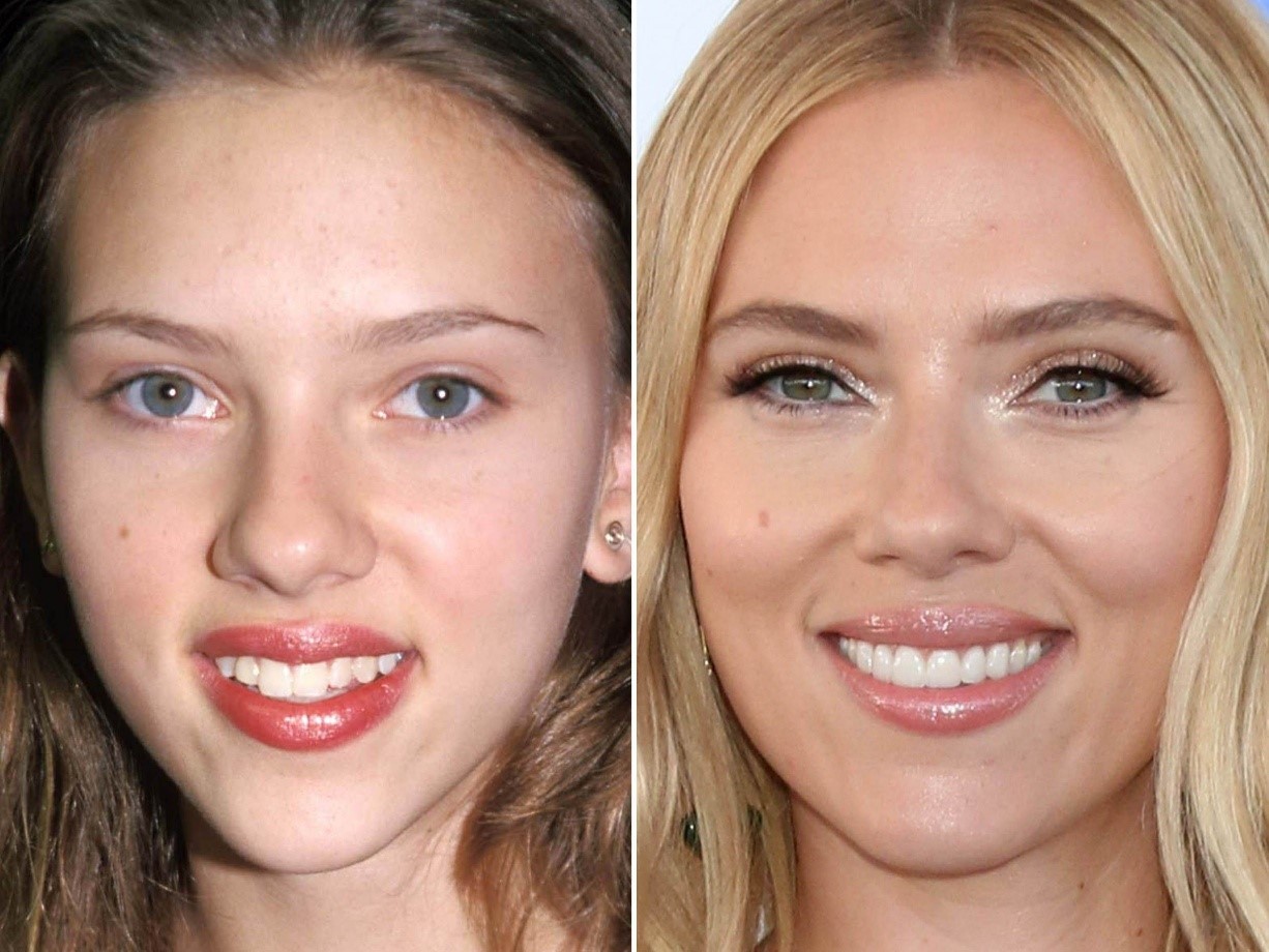 celebrities-with-veneers-Scarlett Johansson celebrities-with-veneers-Scarlett Johansson