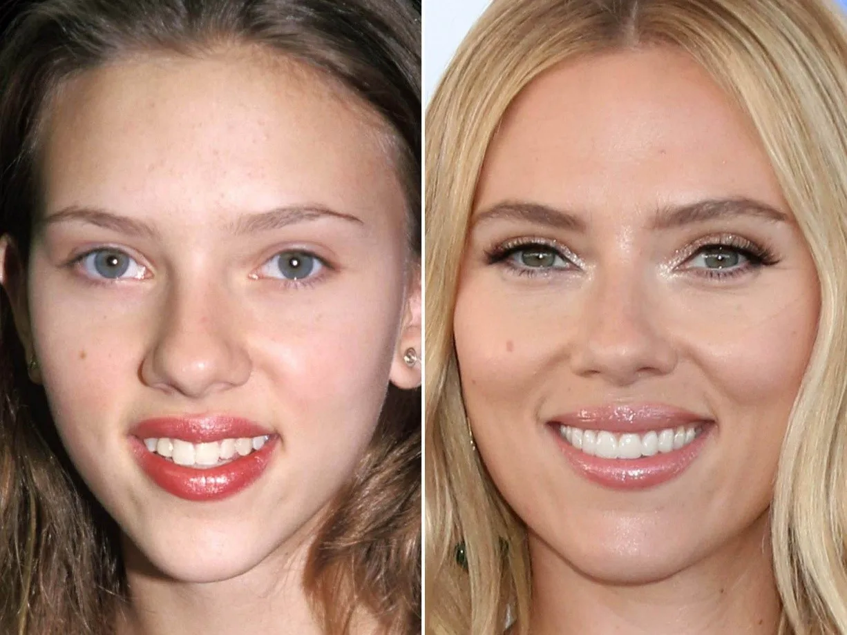 celebrities-with-veneers-Scarlett Johansson celebrities-with-veneers-Scarlett Johansson