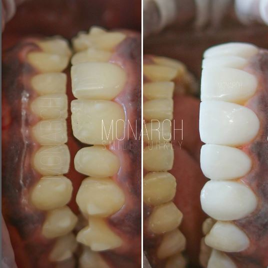 Smile Makeover Before and After in Turkey, Antalya