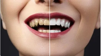 is-it-okey-smoke-after-dental-implants?-antalya-turkey
