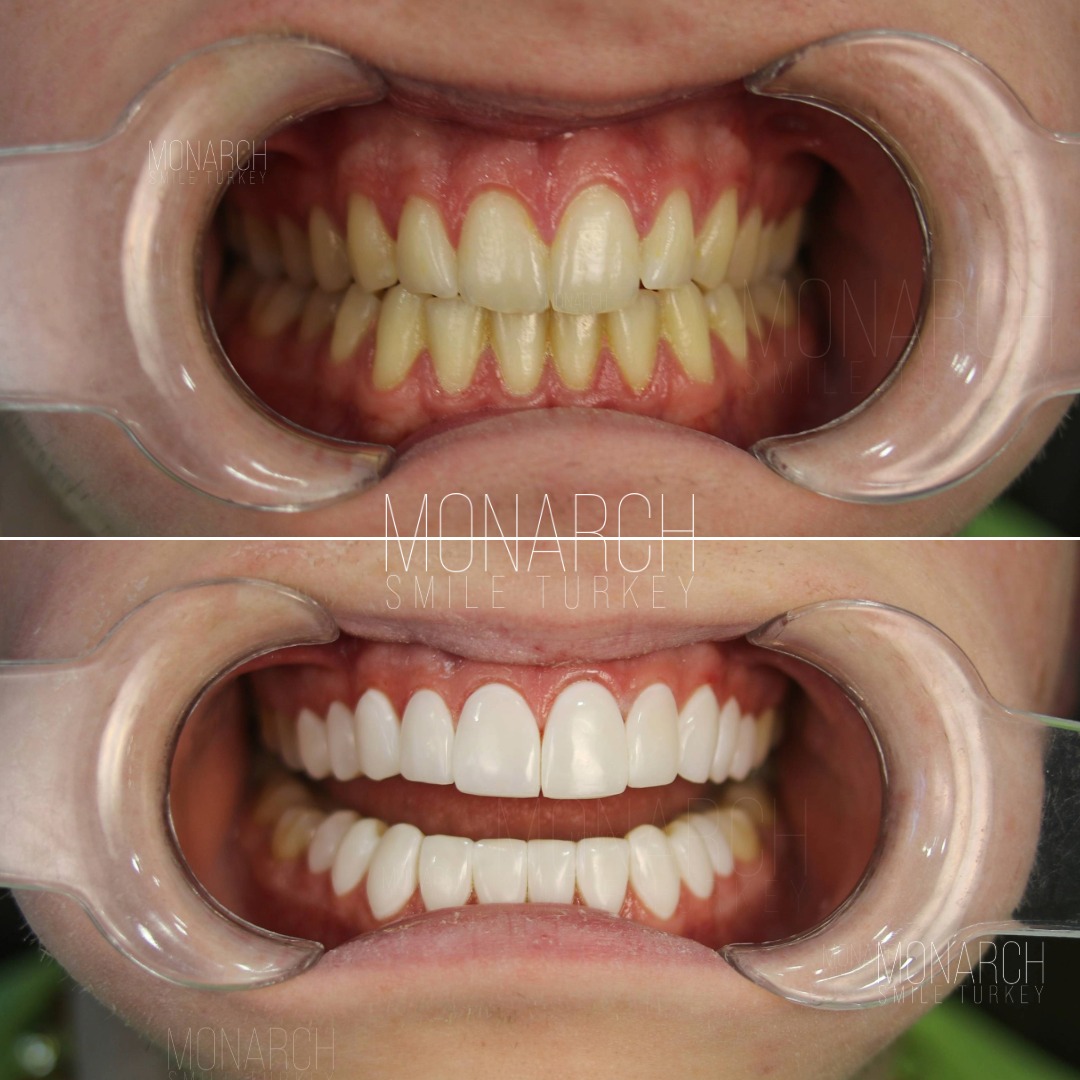 dental veneer-turkey-antalya-3