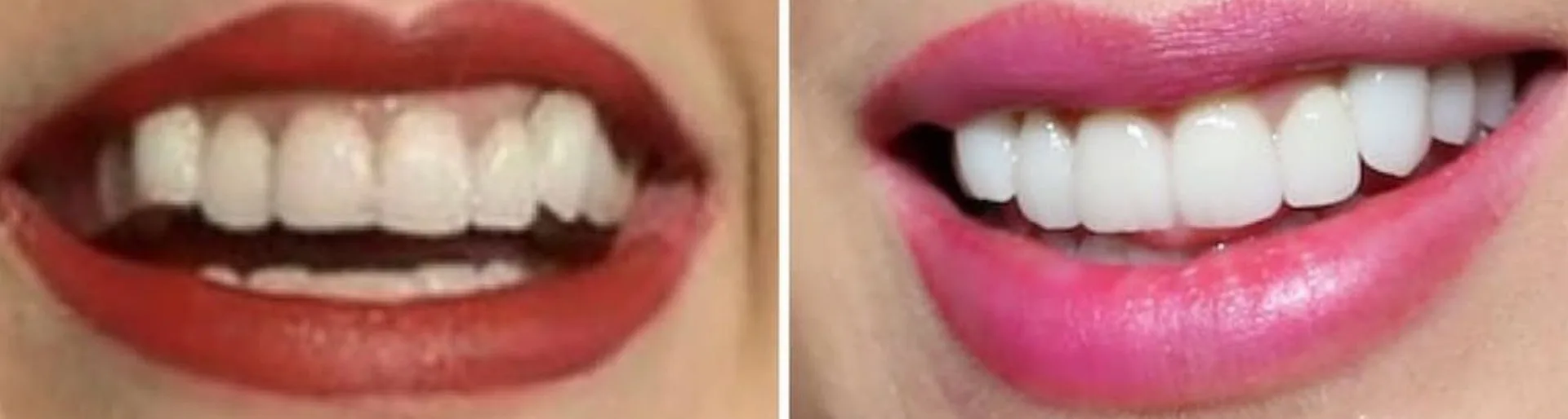 taylor-swift-teeth-before-and-after taylor-swift-teeth-before-and-after