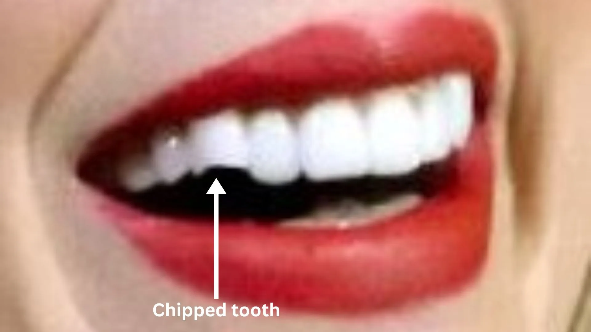 Taylor Swift's chipped tooth