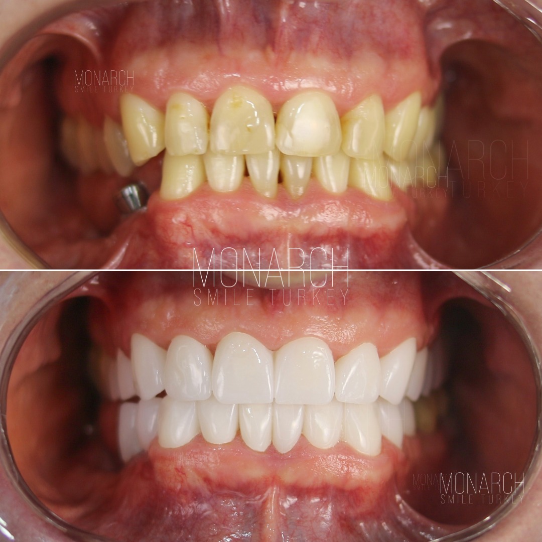 teeth-implant-turkey-1