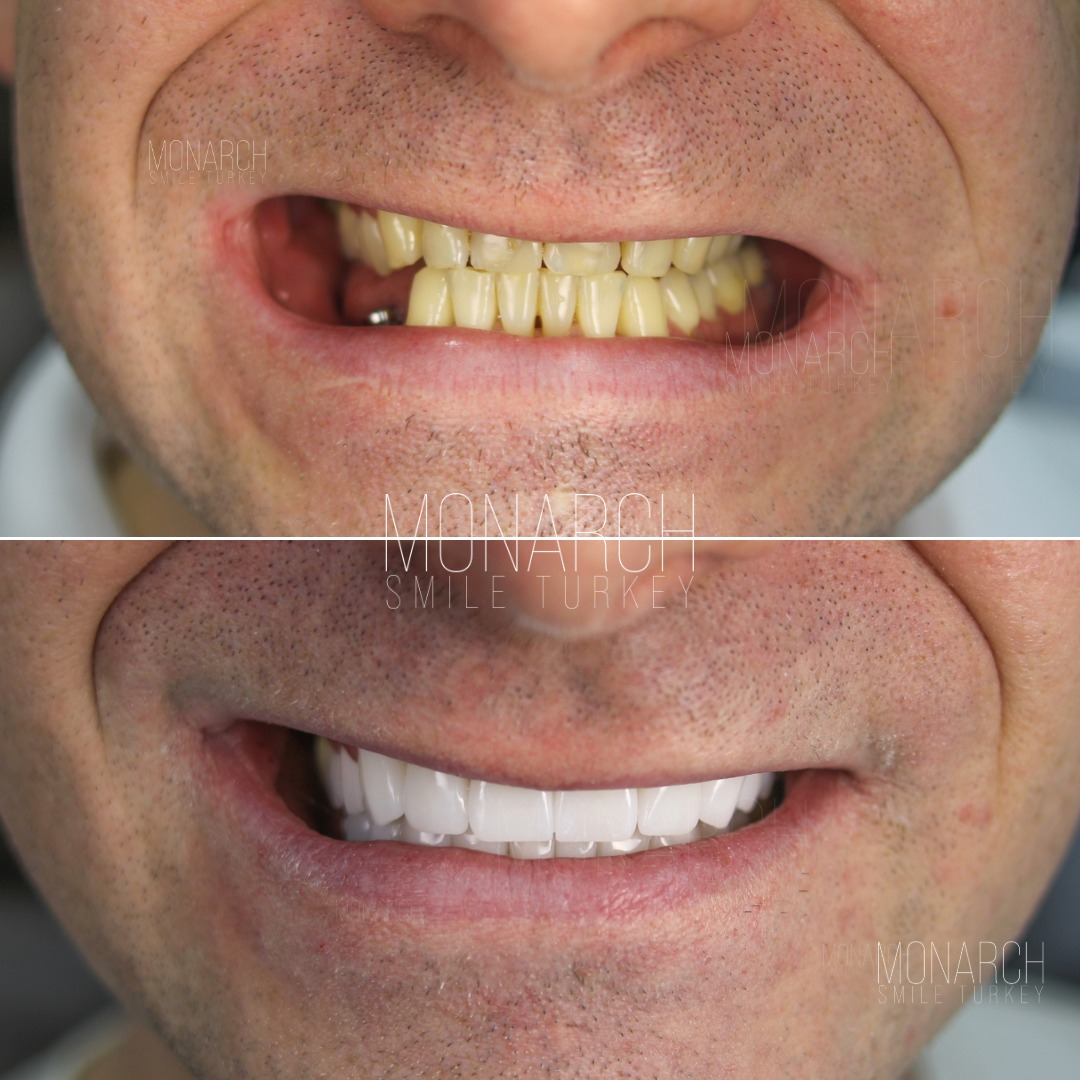 teeth-implant-turkey-2