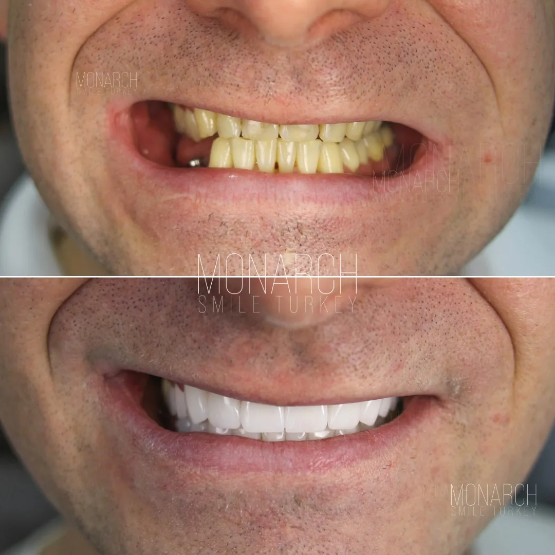 teeth-implant-turkey-2