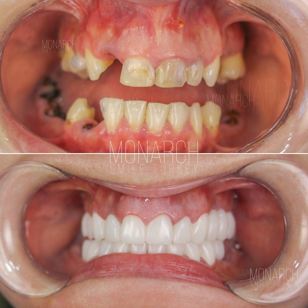 teeth-implant-turkey-1