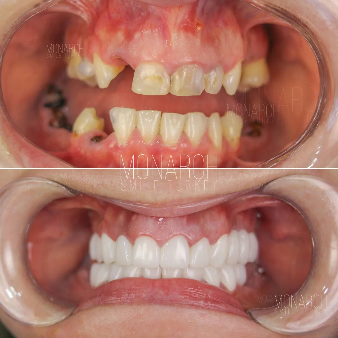 teeth-implant-turkey-1