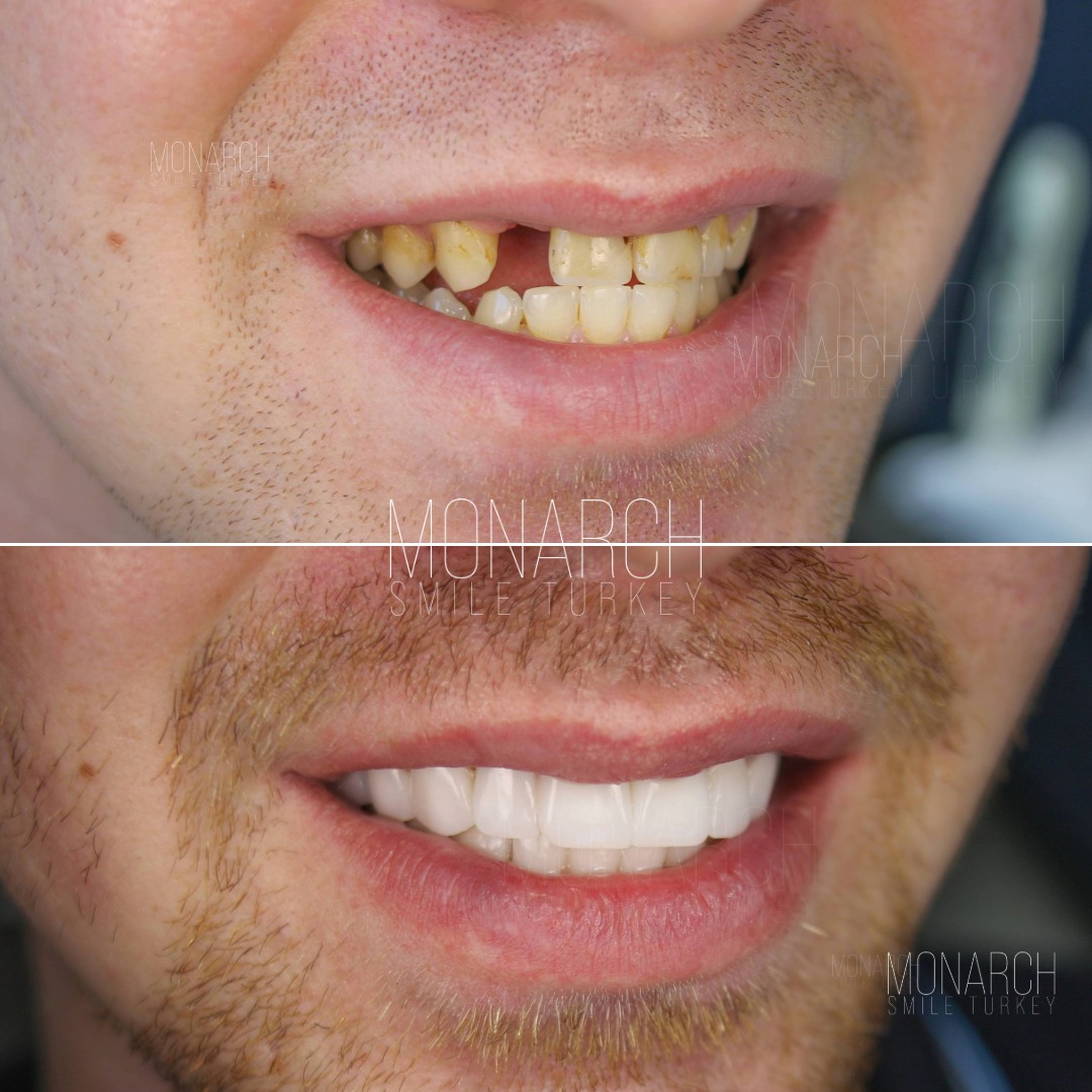 teeth-implant-turkey-5