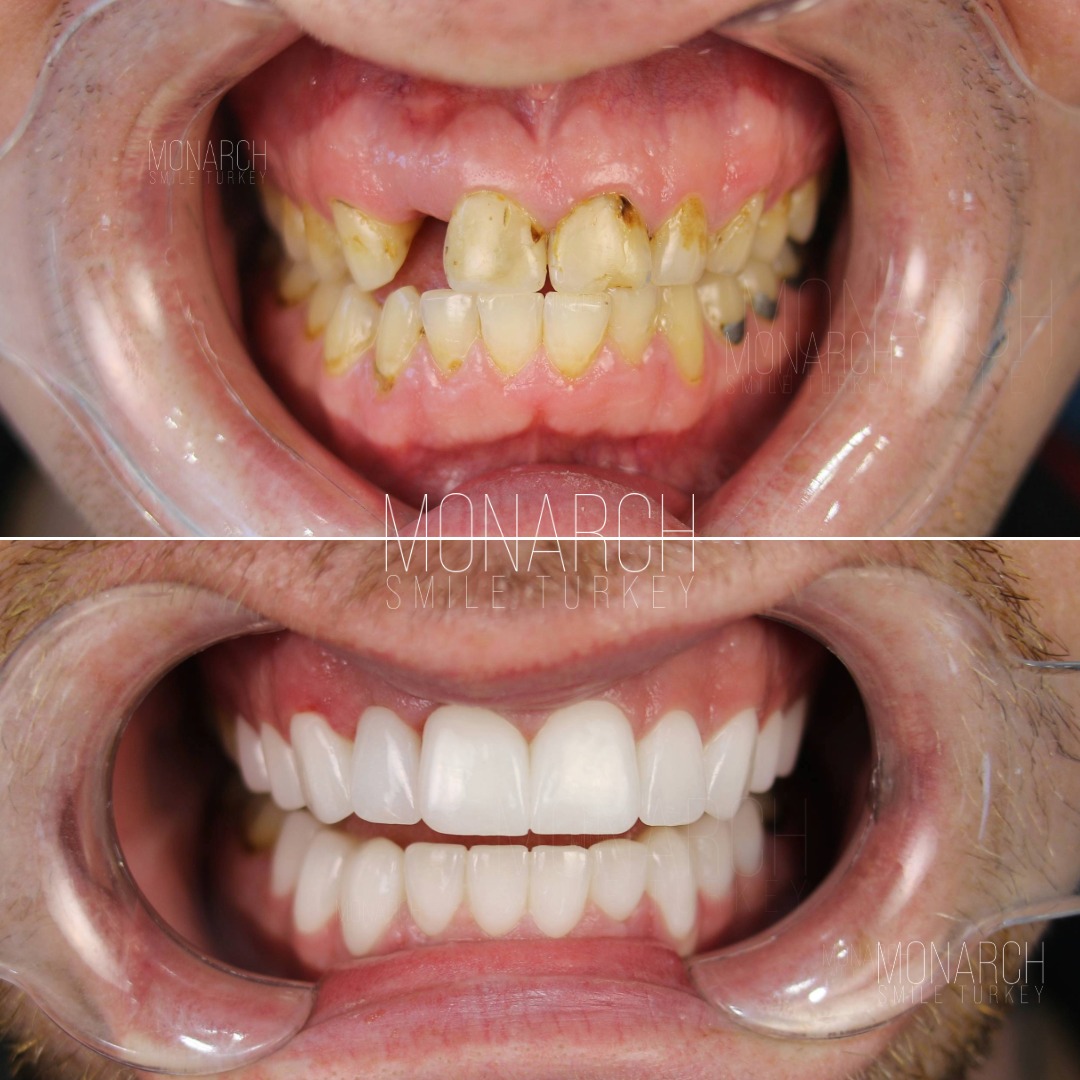 teeth-implant-turkey-6