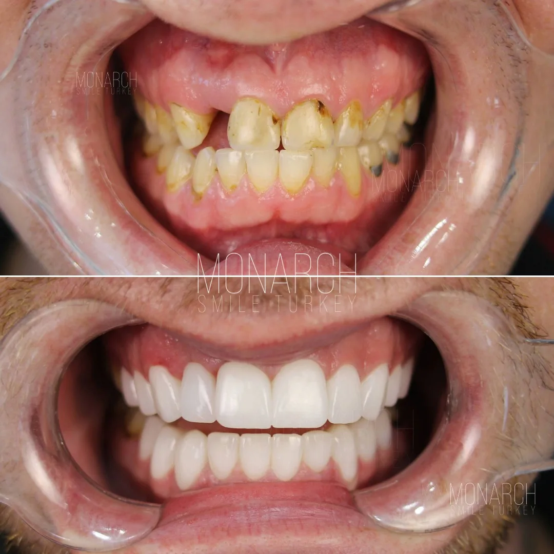 teeth-implant-turkey-6