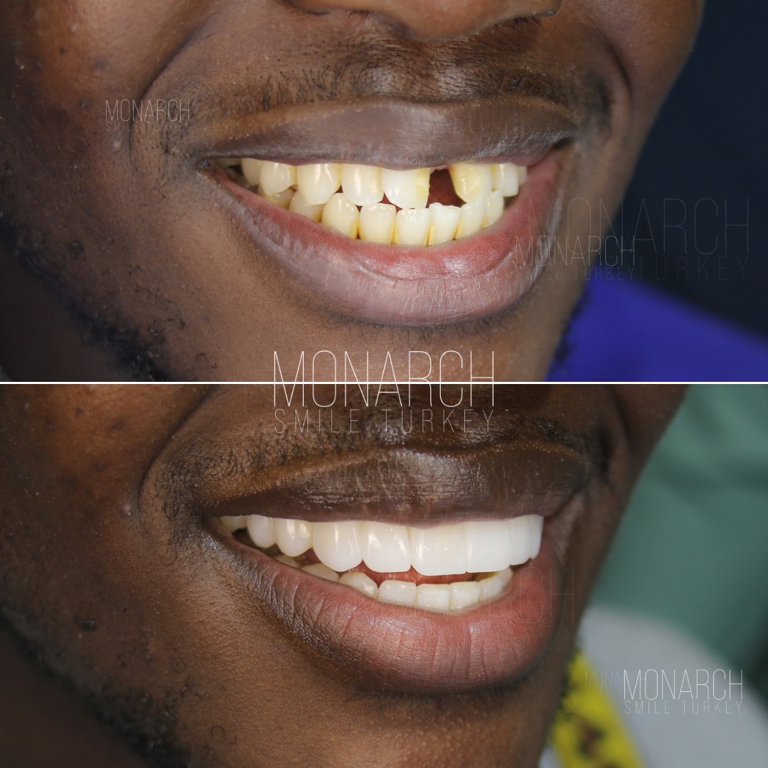 teeth-implant-turkey-7