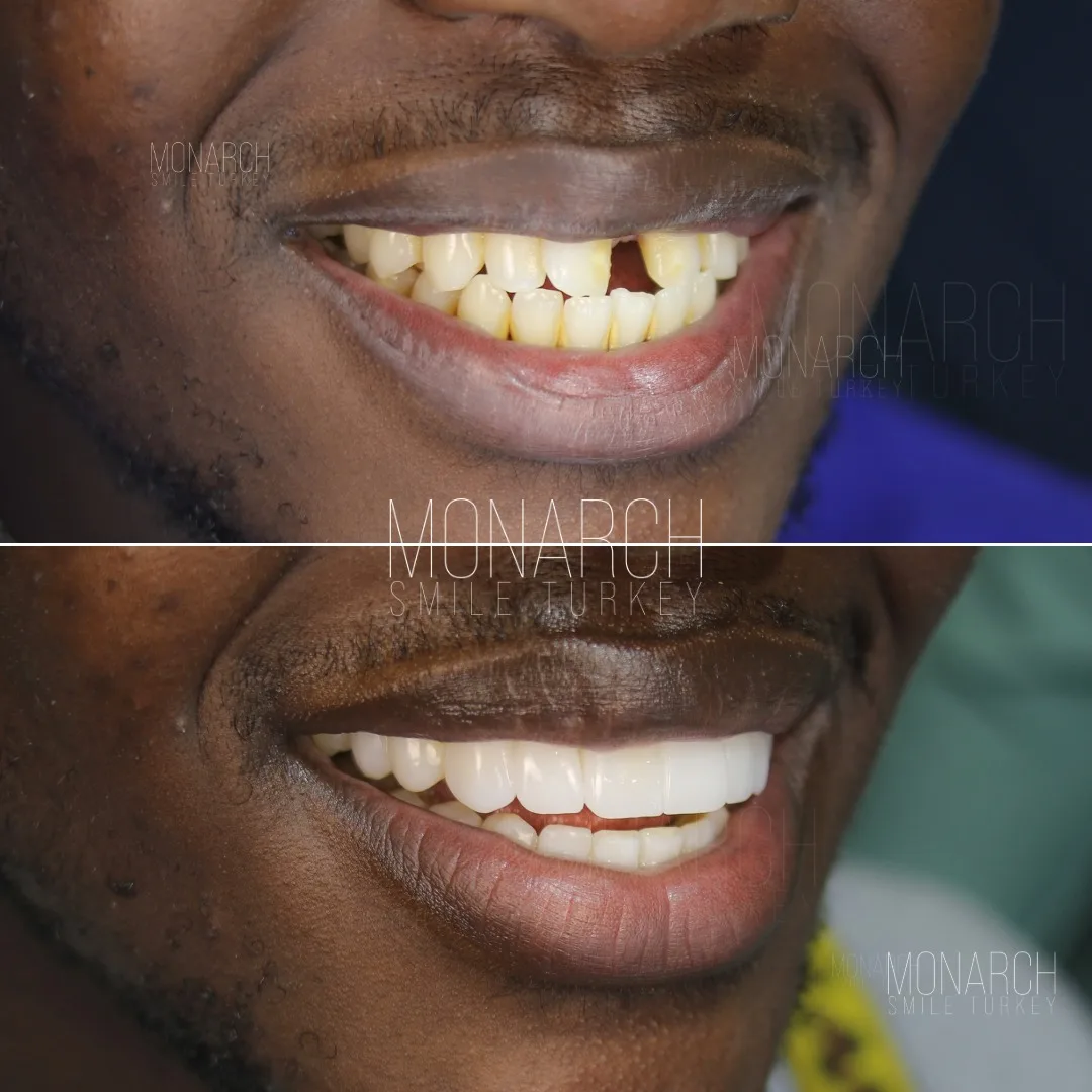 teeth-implant-turkey-7