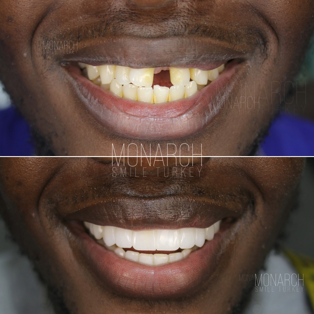 teeth-implant-turkey-8